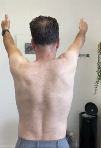 Fysiotherapie bij pijn in de bovenarm bij TopFysio Leeuwarden