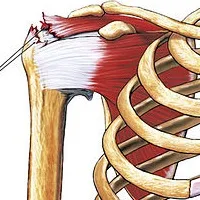 Illustratie van een scheur van de supraspinatuspees in de rotator cuff